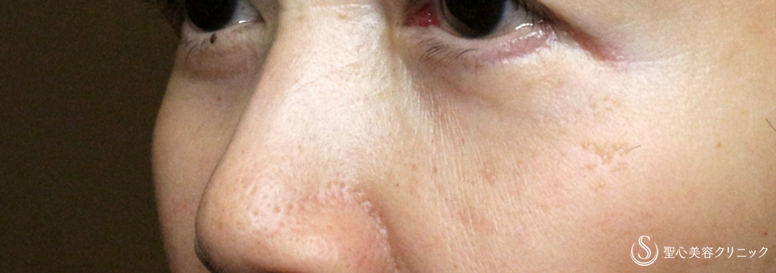 【60代女性・目の下のクマ治療の長期経過】表ハムラ+α法「Ver.2」単独（6年後） After 