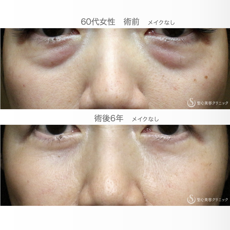 【60代女性・目の下のクマ治療の長期経過】表ハムラ+α法「Ver.2」単独（6年後） After 
