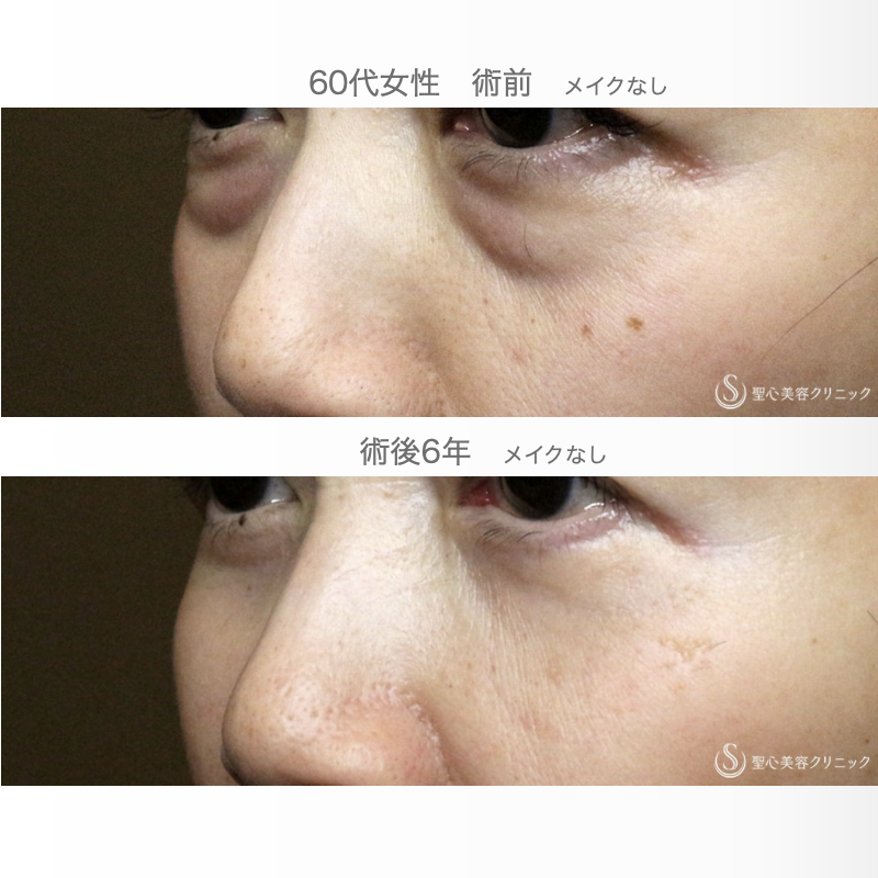 【60代女性・目の下のクマ治療の長期経過】表ハムラ+α法「Ver.2」単独（6年後） After 