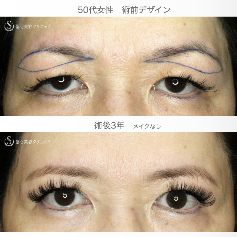 【50代女性・劇的ビフォーアフター】眉下リフト+α単独（3年後） After 