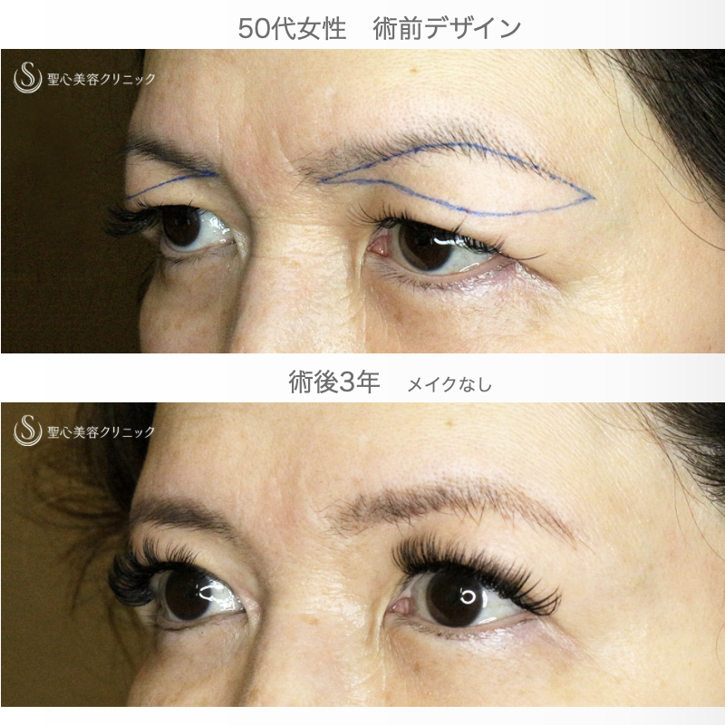 【50代女性・劇的ビフォーアフター】眉下リフト+α単独（3年後） After 