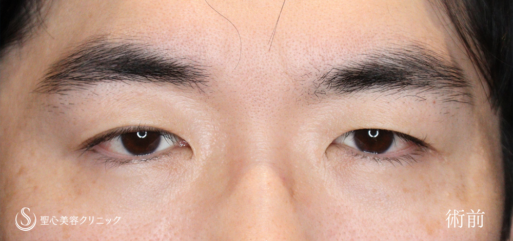 【40代男性・二重幅を広げず目の開きを劇的に改善】 眼瞼下垂（切開法/腱膜縫縮法）（4か月後） Before 