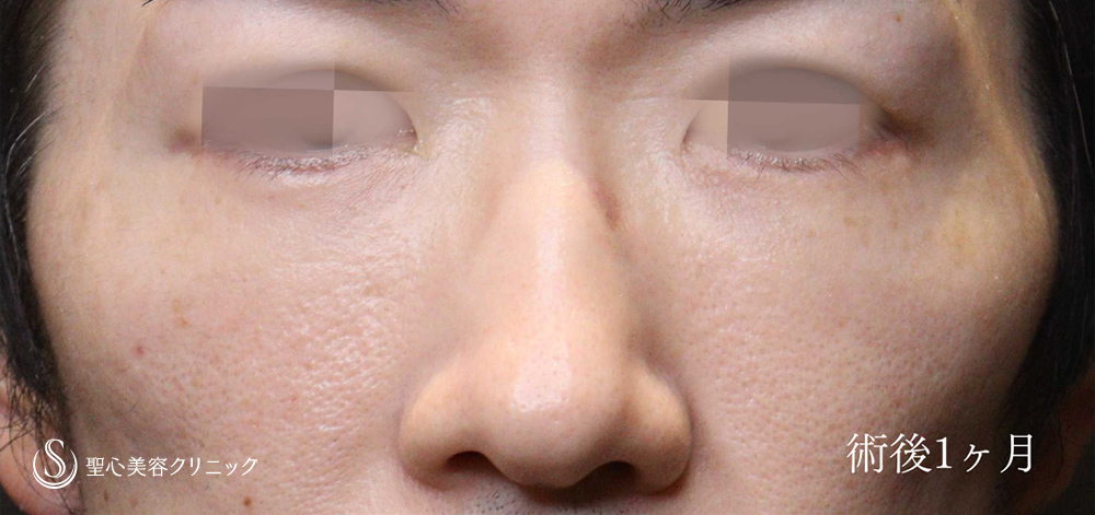 【40代男性・ハムラ法で目のクマ・たるみを改善】ハムラ法（脂肪移動＋たるみ除去）（1か月後） After 