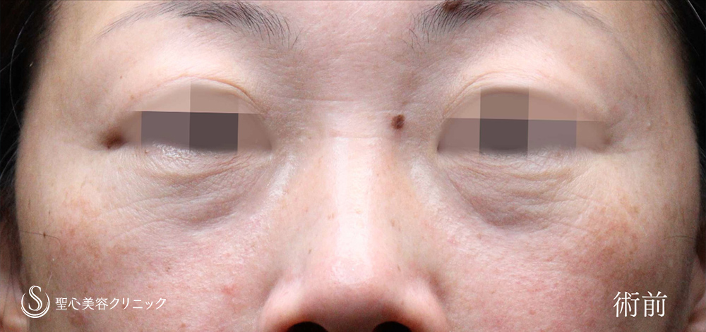 【40代女性・注射で目の下のクマを劇的に改善】プレミアムPRP皮膚再生療法（目の下のくま）（3ヶ月後） Before 