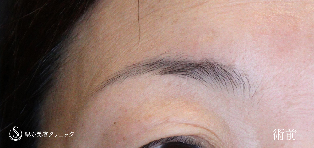【40代女性・眉下リフトで上瞼（まぶた）のたるみを改善】眉下切開法（眉下リフト）（3か月後） Before 