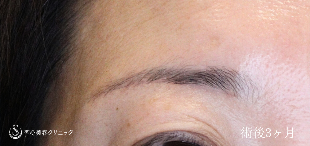 【40代女性・眉下リフトで上瞼（まぶた）のたるみを改善】眉下切開法（眉下リフト）（3か月後） After 