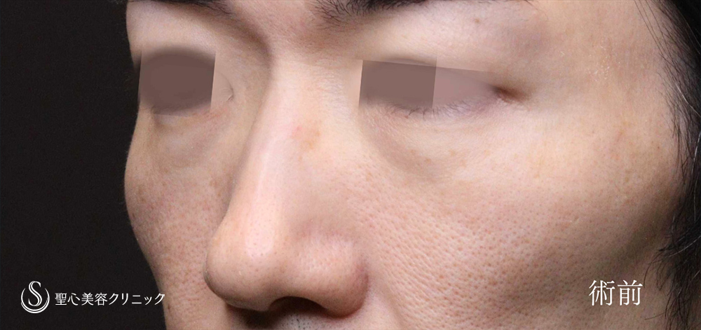 【40代男性・ハムラ法で目のクマ・たるみを改善】ハムラ法（脂肪移動＋たるみ除去）（1か月後） Before 