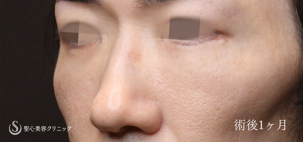 【40代男性・ハムラ法で目のクマ・たるみを改善】ハムラ法（脂肪移動＋たるみ除去）（1か月後） After 
