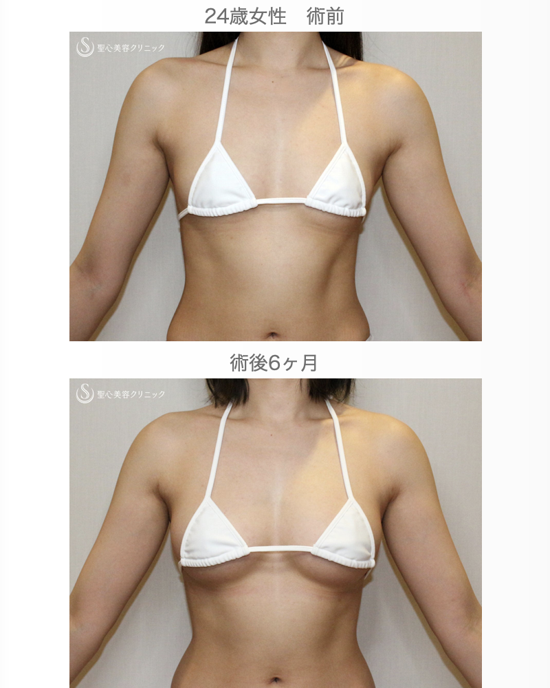 【24歳女性・まるでバッグ豊胸の術後みたい？「脂肪幹細胞豊胸」】プレミアムセリューション豊胸術（6ヶ月後） After 