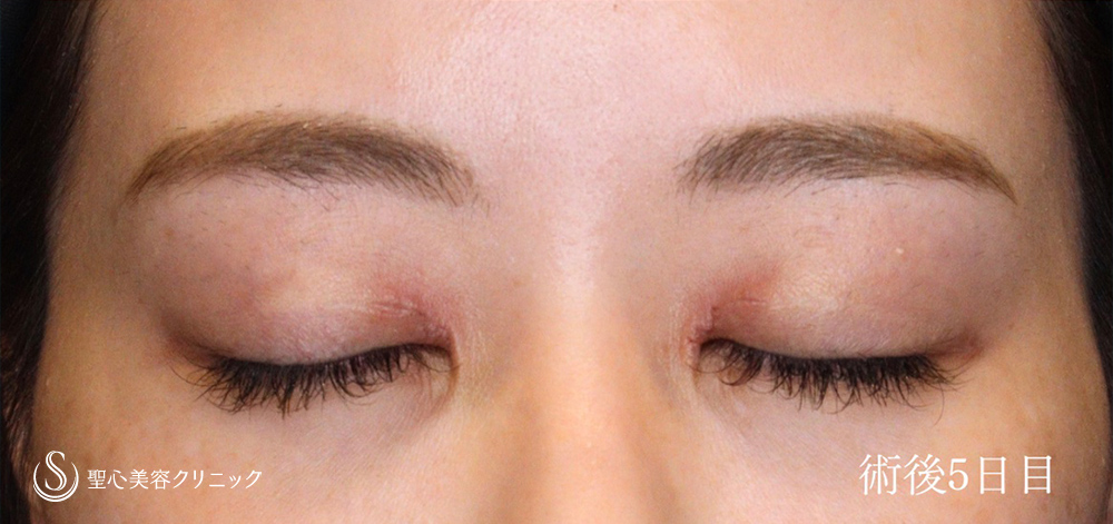 【20代女性・目上切開でヒダを解消し、平行二重に】目上切開（5日後） After 