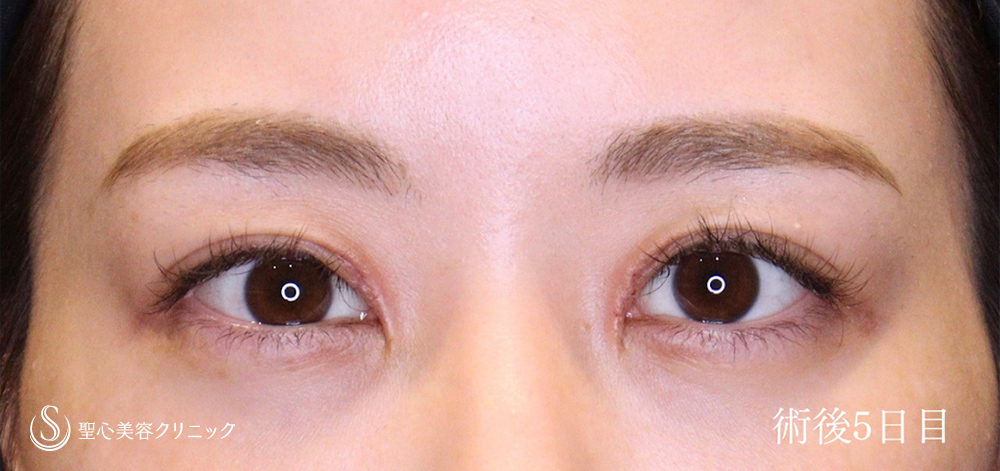 【20代女性・目上切開でヒダを解消し、平行二重に】目上切開（5日後） After 