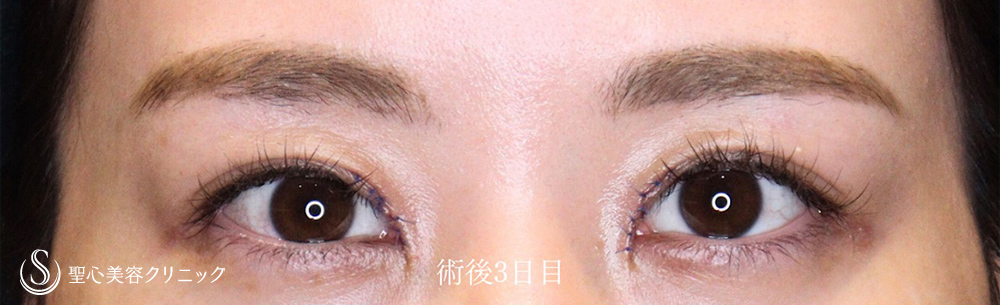 【20代女性・目上切開でヒダを解消し、平行二重に】目上切開（5日後） After 