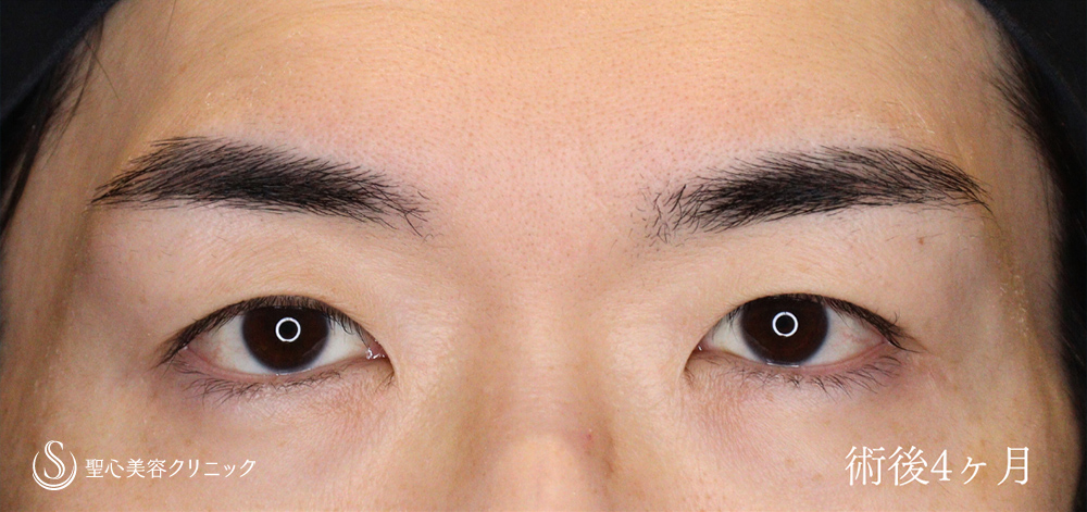 【40代男性・二重幅を広げず目の開きを劇的に改善】 眼瞼下垂（切開法/腱膜縫縮法）（4か月後） After 