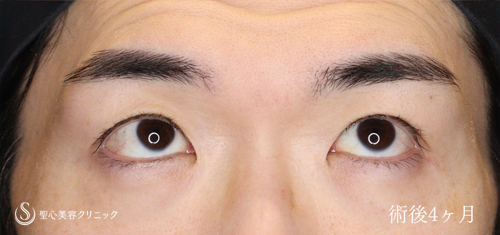 【40代男性・二重幅を広げず目の開きを劇的に改善】 眼瞼下垂（切開法/腱膜縫縮法）（4か月後） After 