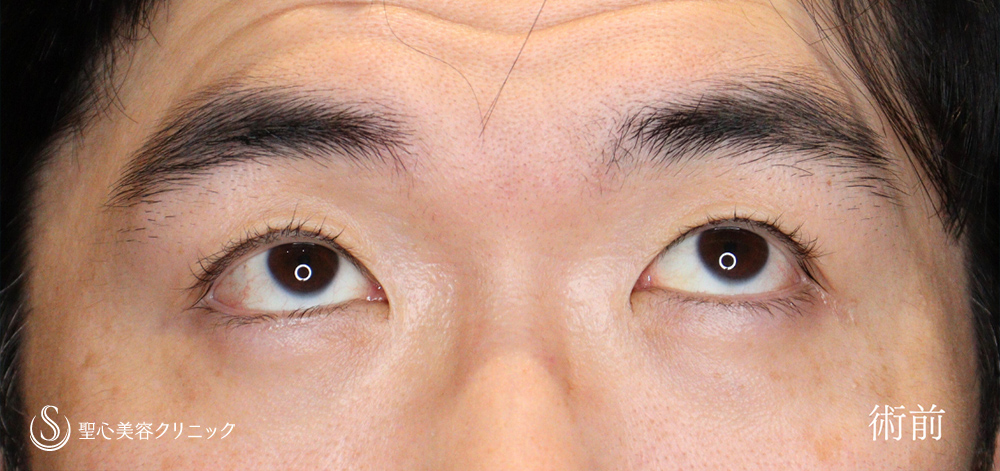 【40代男性・二重幅を広げず目の開きを劇的に改善】 眼瞼下垂（切開法/腱膜縫縮法）（4か月後） Before 
