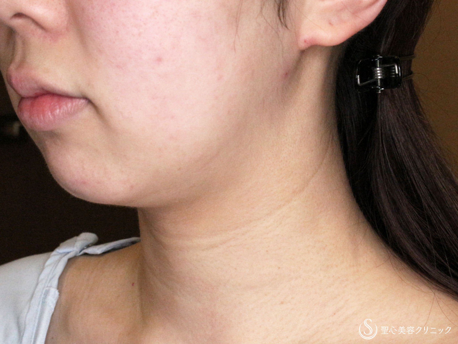 【20代女性・シリンジで二重あご解消】あご下脂肪吸引注射（直後〜1年2ヶ月後） Before 