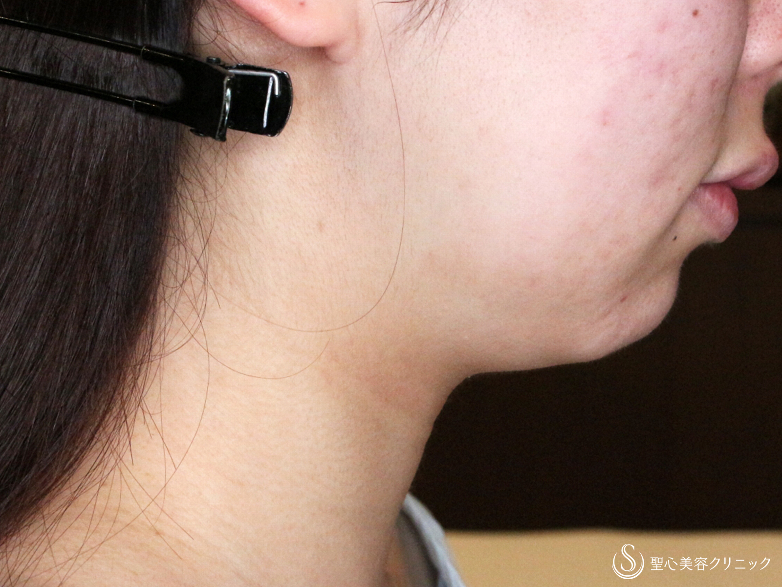 【20代女性・シリンジで二重あご解消】あご下脂肪吸引注射（直後〜1年2ヶ月後） Before 