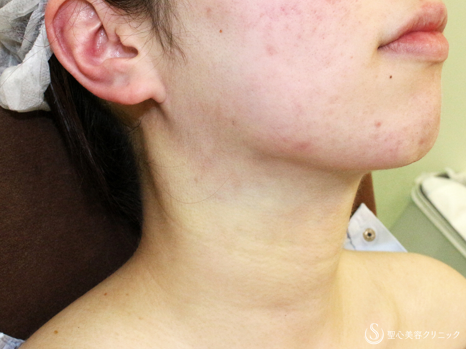 【20代女性・シリンジで二重あご解消】あご下脂肪吸引注射（直後〜1年2ヶ月後） Before 