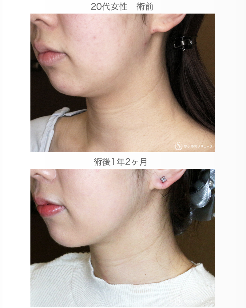 【20代女性・シリンジで二重あご解消】あご下脂肪吸引注射（直後〜1年2ヶ月後） After 