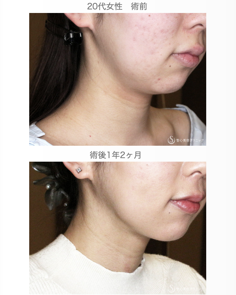 【20代女性・シリンジで二重あご解消】あご下脂肪吸引注射（直後〜1年2ヶ月後） After 