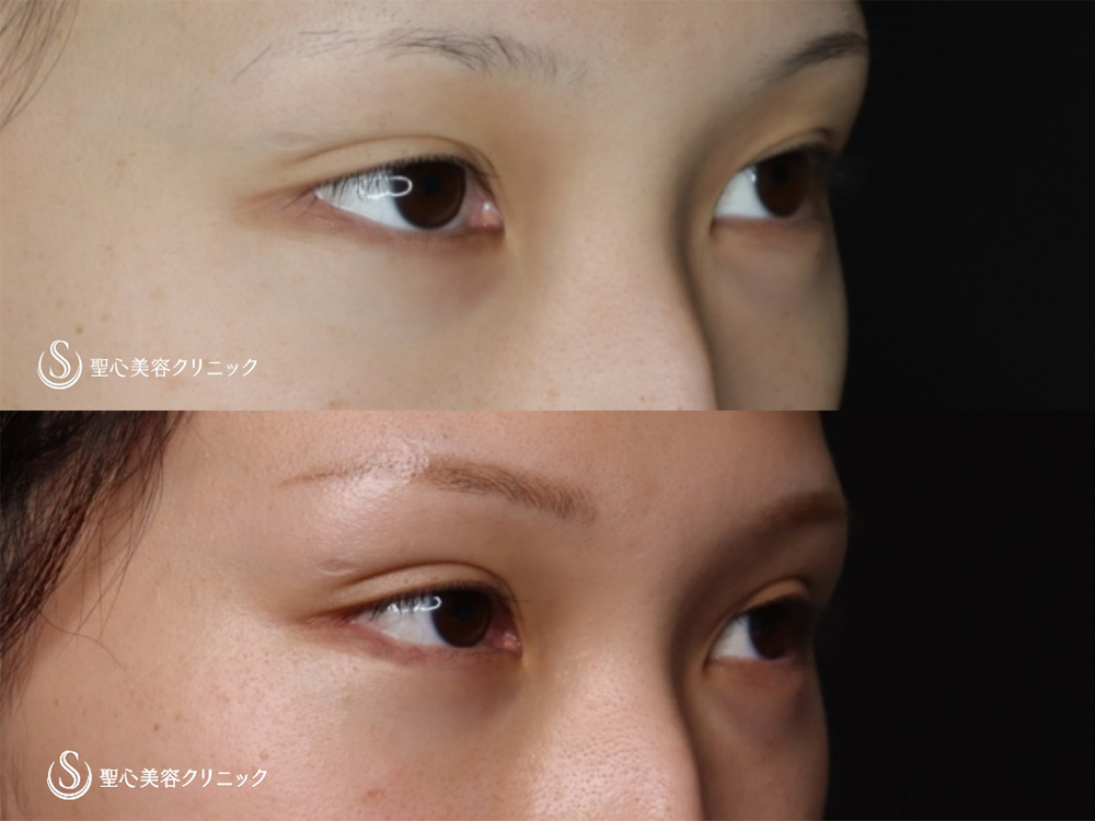 【20代女性・少しずつの変化で目元を華やかに】 マイクロメソッド+α（二重埋没法）＋グラマラスライン形成（切開法）＋目尻切開（3ヶ月後） After 