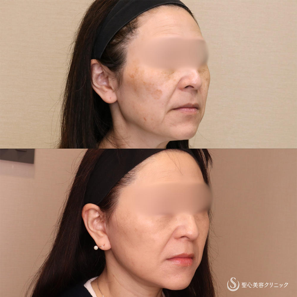 【50代女性・切開リフトですっきり】フェイスリフト＋脂肪吸引（頬）＋リガメント処理（2ヶ月後） After 