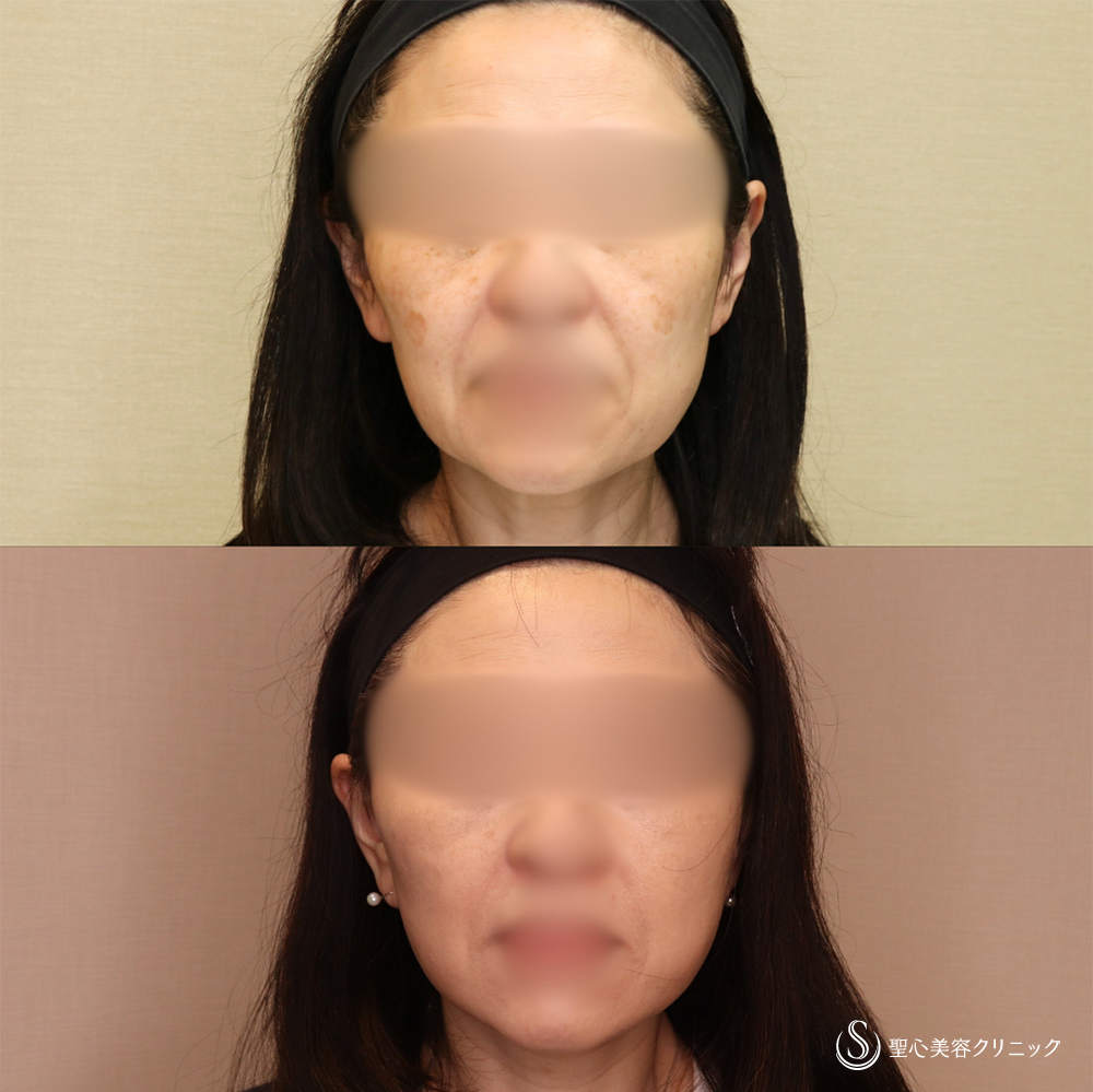 【50代女性・切開リフトですっきり】フェイスリフト＋脂肪吸引（頬）＋リガメント処理（2ヶ月後） After 