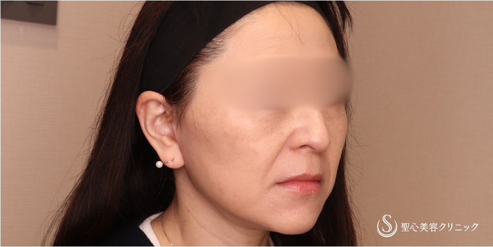 【50代女性・切開リフトですっきり】フェイスリフト＋脂肪吸引（頬）＋リガメント処理（2ヶ月後） After 