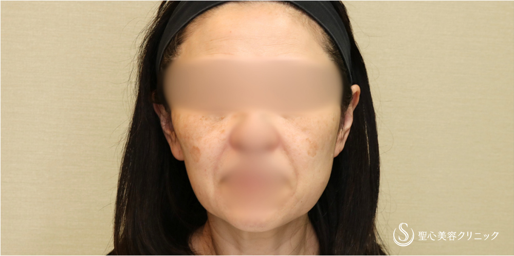 【50代女性・切開リフトですっきり】フェイスリフト＋脂肪吸引（頬）＋リガメント処理（2ヶ月後） Before 