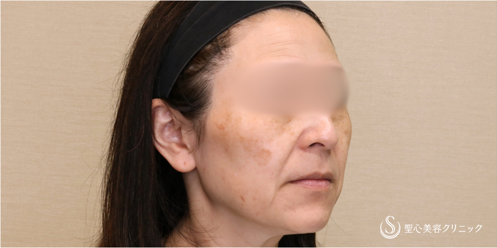 【50代女性・切開リフトですっきり】フェイスリフト＋脂肪吸引（頬）＋リガメント処理（2ヶ月後） Before 