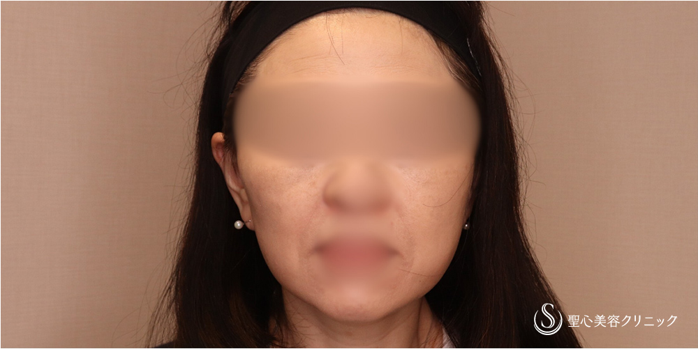 【50代女性・切開リフトですっきり】フェイスリフト＋脂肪吸引（頬）＋リガメント処理（2ヶ月後） After 