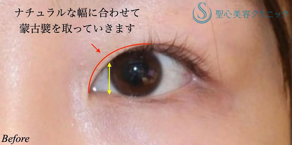 【20代女性・目元の印象が柔らかく】目上切開（術後3ヶ月） Before 