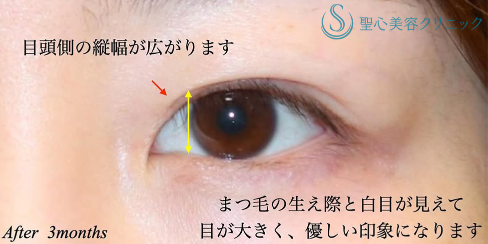 【20代女性・目元の印象が柔らかく】目上切開（術後3ヶ月） After 
