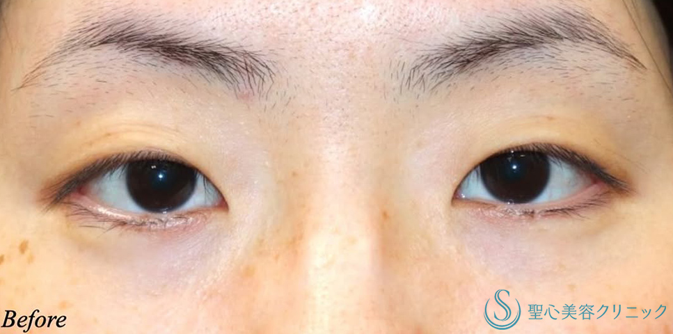 【30代女性・まつ毛の生え際が見える綺麗な二重】二重術（切開法）＋目頭切開/目上切開（術後3ヶ月） Before 