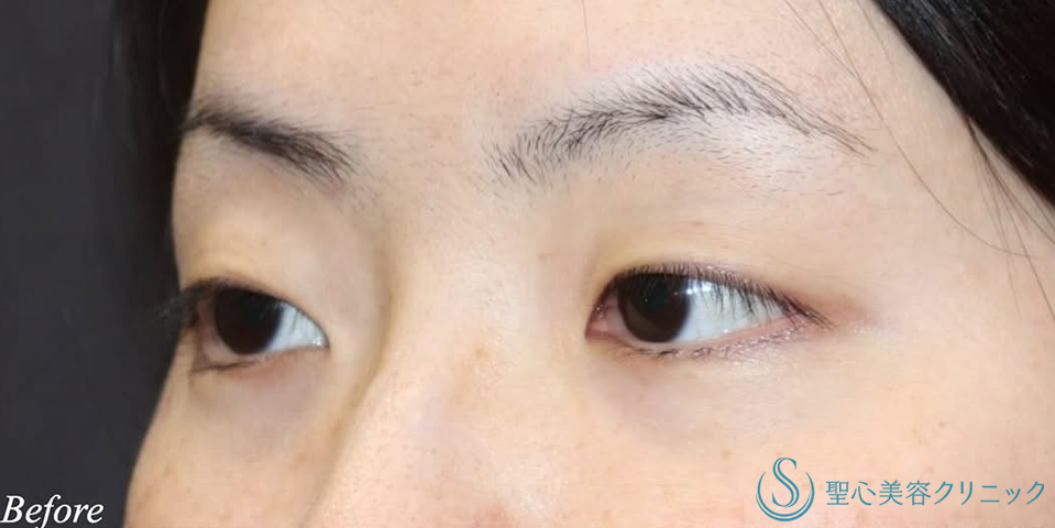 【30代女性・まつ毛の生え際が見える綺麗な二重】二重術（切開法）＋目頭切開/目上切開（術後3ヶ月） Before 