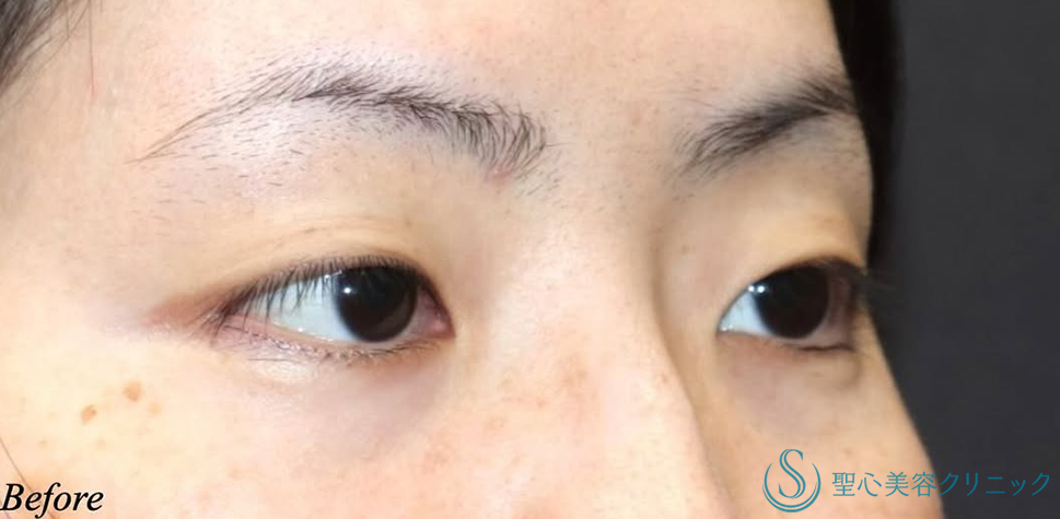 【30代女性・まつ毛の生え際が見える綺麗な二重】二重術（切開法）＋目頭切開/目上切開（術後3ヶ月） Before 