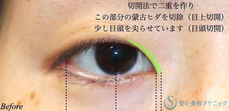 【30代女性・まつ毛の生え際が見える綺麗な二重】二重術（切開法）＋目頭切開/目上切開（術後3ヶ月） Before 