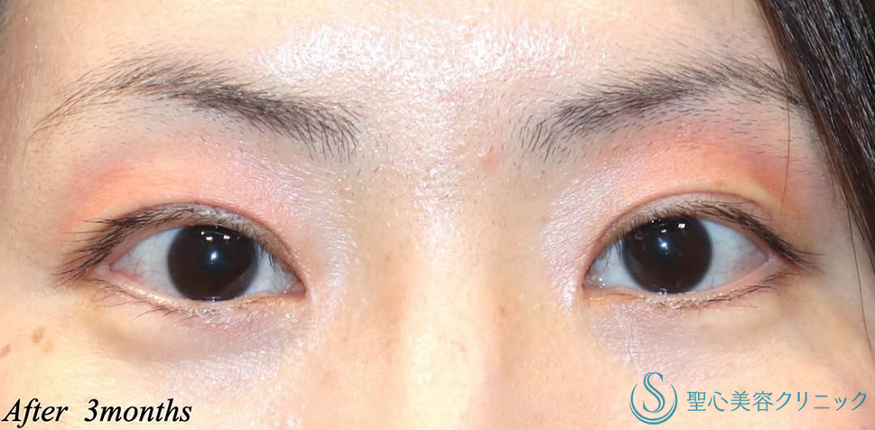 【30代女性・まつ毛の生え際が見える綺麗な二重】二重術（切開法）＋目頭切開/目上切開（術後3ヶ月） After 