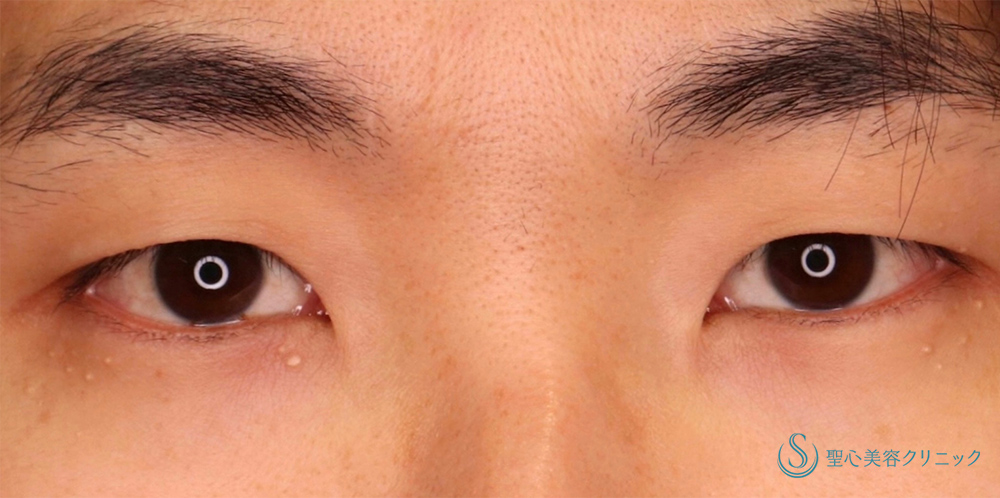 【30代男性・ナチュラルで格好いい二重に】眉下切開法（眉下リフト）＋マイクロメソッド+α（3点固定）（1ヶ月後） Before 