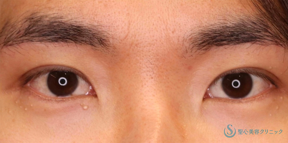 【30代男性・ナチュラルで格好いい二重に】眉下切開法（眉下リフト）＋マイクロメソッド+α（3点固定）（1ヶ月後） After 