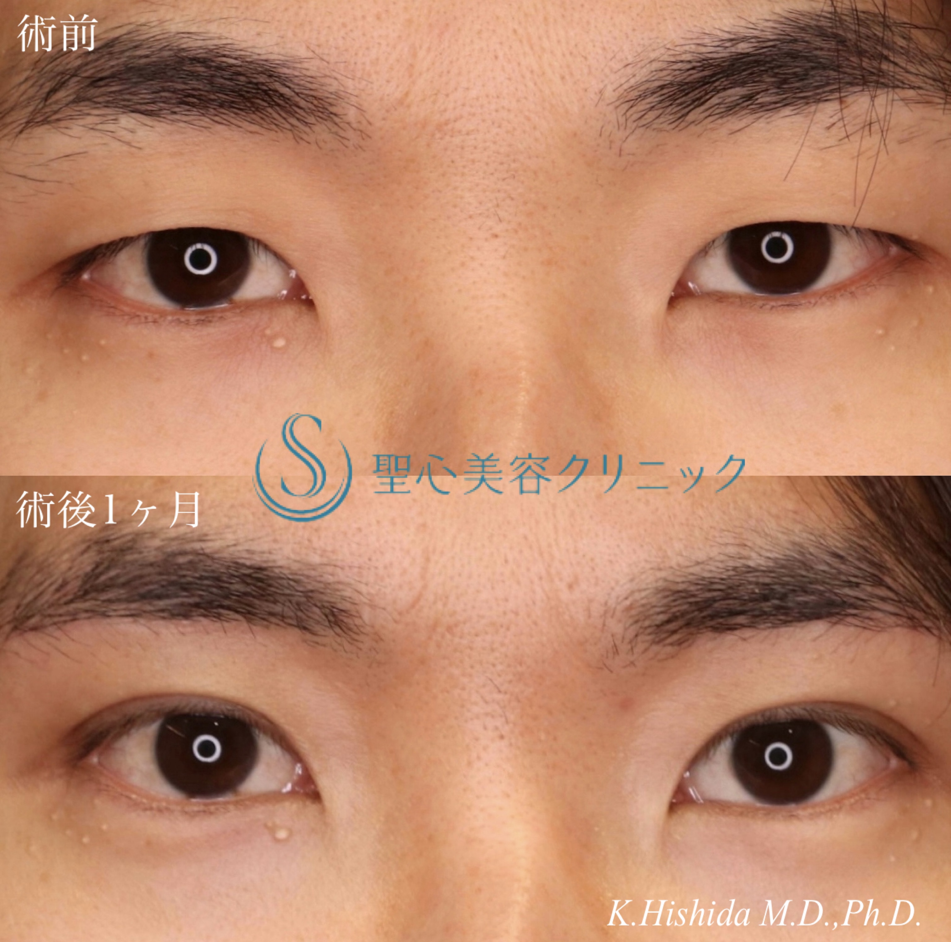 【30代男性・ナチュラルで格好いい二重に】眉下切開法（眉下リフト）＋マイクロメソッド+α（3点固定）（1ヶ月後） After 