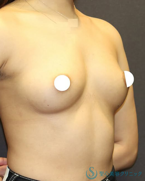 【20代女性・自然で美しいバストに】バッグプロテーゼ挿入法（術後1ヶ月） Before 