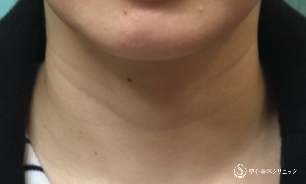 【30代女性・首の横じわの改善】プレミアムPRP皮膚再生療法（4年後） Before 