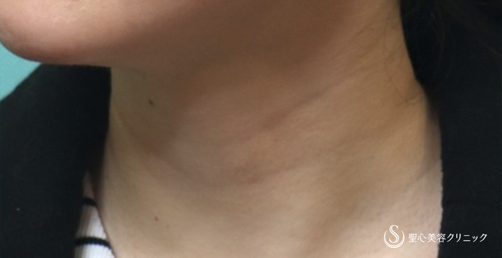 【30代女性・首の横じわの改善】プレミアムPRP皮膚再生療法（4年後） Before 