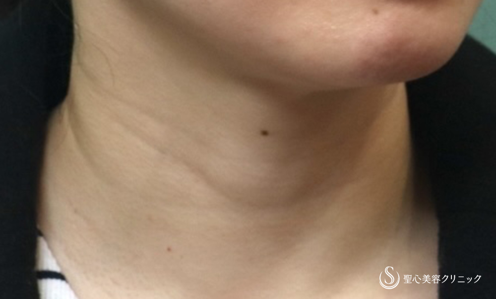 【30代女性・首の横じわの改善】プレミアムPRP皮膚再生療法（4年後） Before 