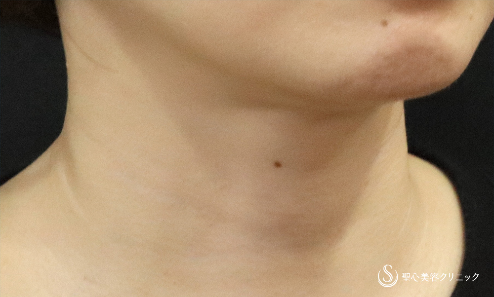 【30代女性・首の横じわの改善】プレミアムPRP皮膚再生療法（4年後） After 