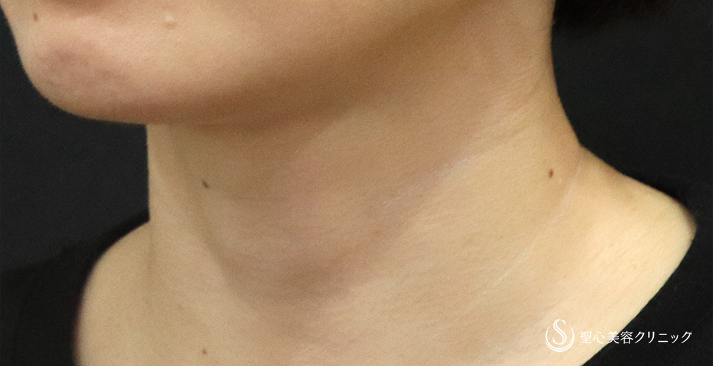 【30代女性・首の横じわの改善】プレミアムPRP皮膚再生療法（4年後） After 