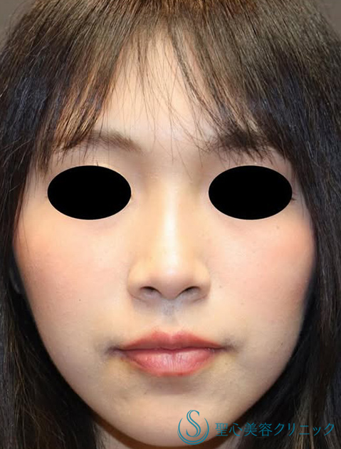 【20代女性・ナチュラルな小鼻】小鼻縮小（術後2ヶ月） Before 