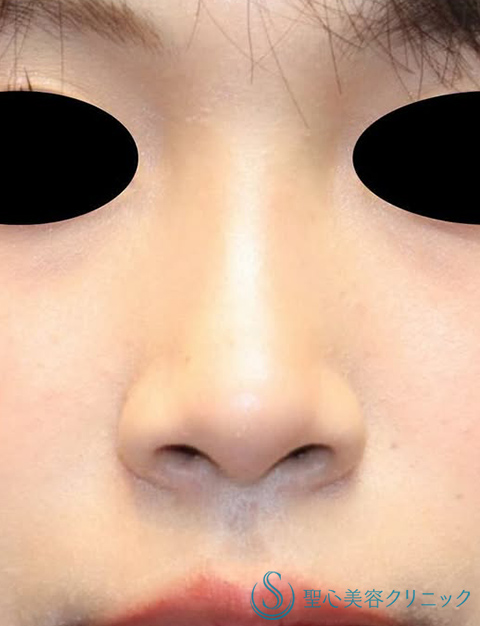【20代女性・ナチュラルな小鼻】小鼻縮小（術後2ヶ月） Before 