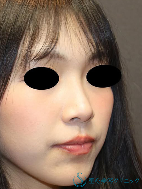 【20代女性・ナチュラルな小鼻】小鼻縮小（術後2ヶ月） Before 